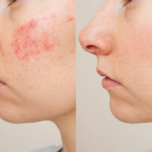 Curso de Lavieen para Harmonização Facial